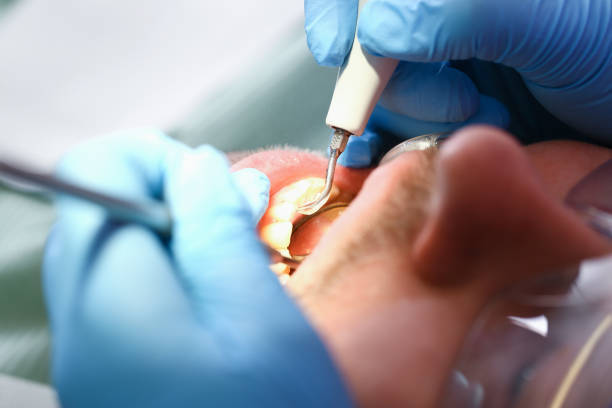 Best Emergency Treatment for Dental Infections or Abscesses in Story City, IA